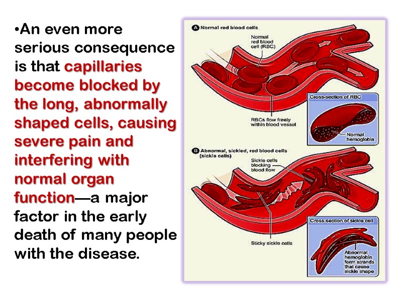 An even more serious consequence is that capillaries become blocked by the long, abnormally